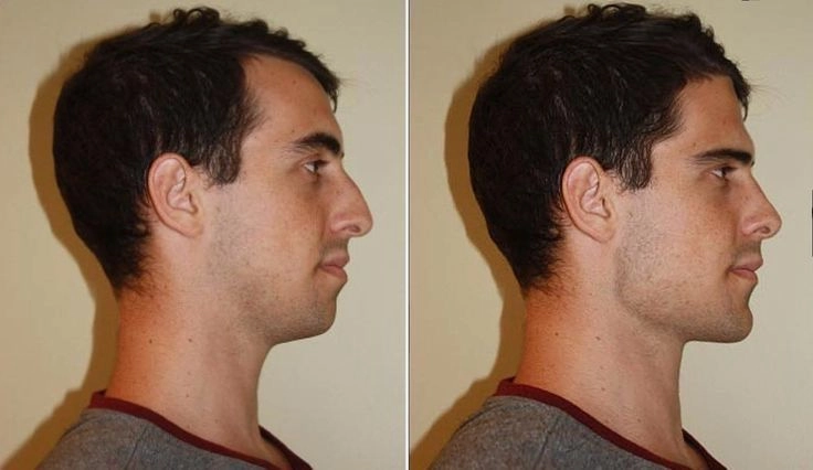 JAWTOX BEFORE AND AFTER